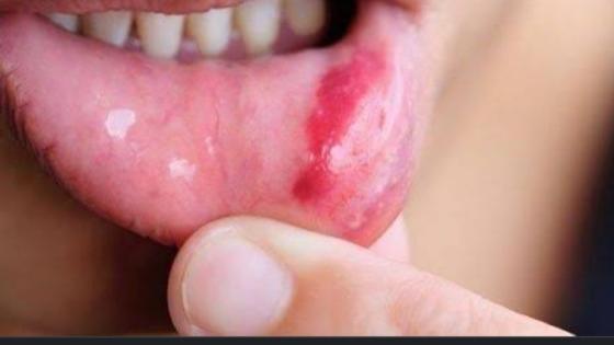 أشهر أربع علامات لسرطان الفم أطباء ومتخصصون المملكة توضح